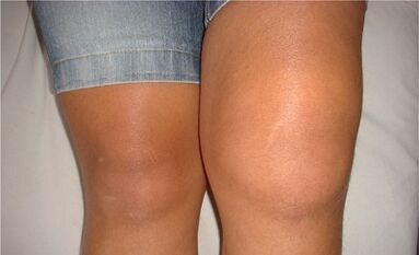 The causes of the arthritic of the knee joint