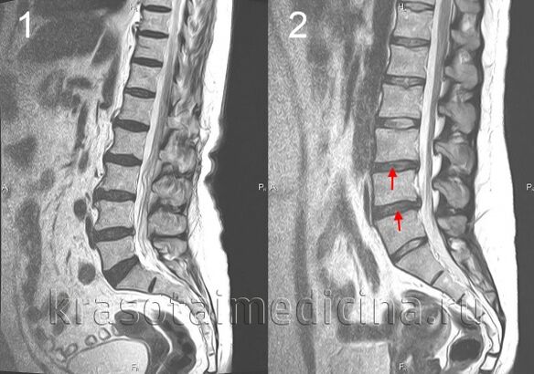 Spine osteochondria
