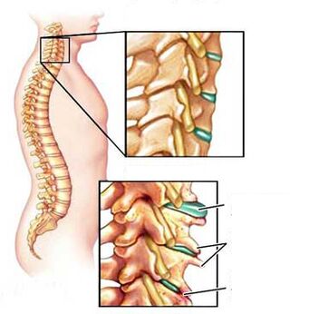 Comparison of a healthy and sick vertebral in the throat