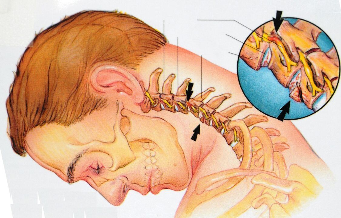 Osteochondria of cervical area