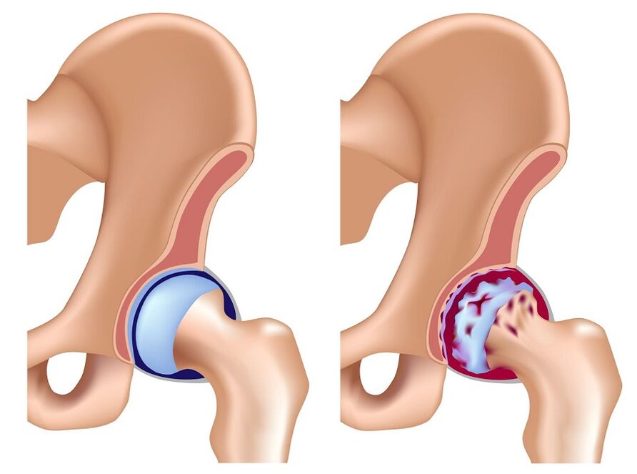 Healthy joint and articulation of hip joint