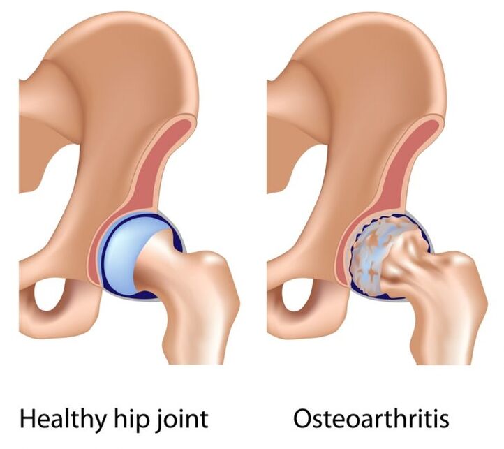healthy joint and arthropathy of the hip joint